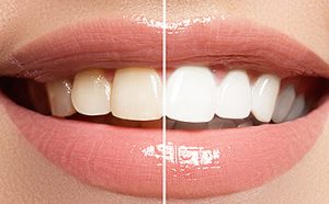 Bleaching nach der Zahnspange - Zähne aufhellen Salzgitter